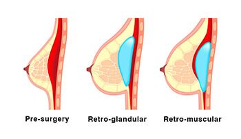 Illustration showing the location of implants with retro-glandular and retro-muscular placement