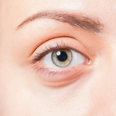 Eye with signs of aging