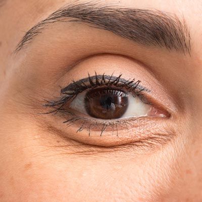 Eye with signs of aging