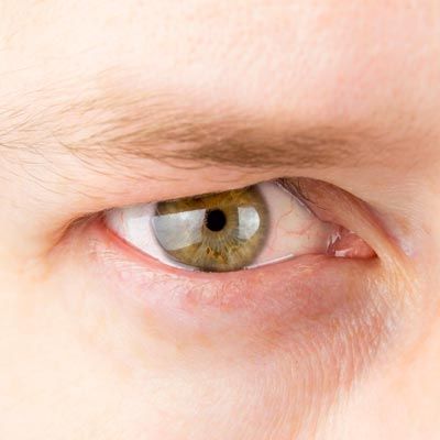 Eye with signs of aging