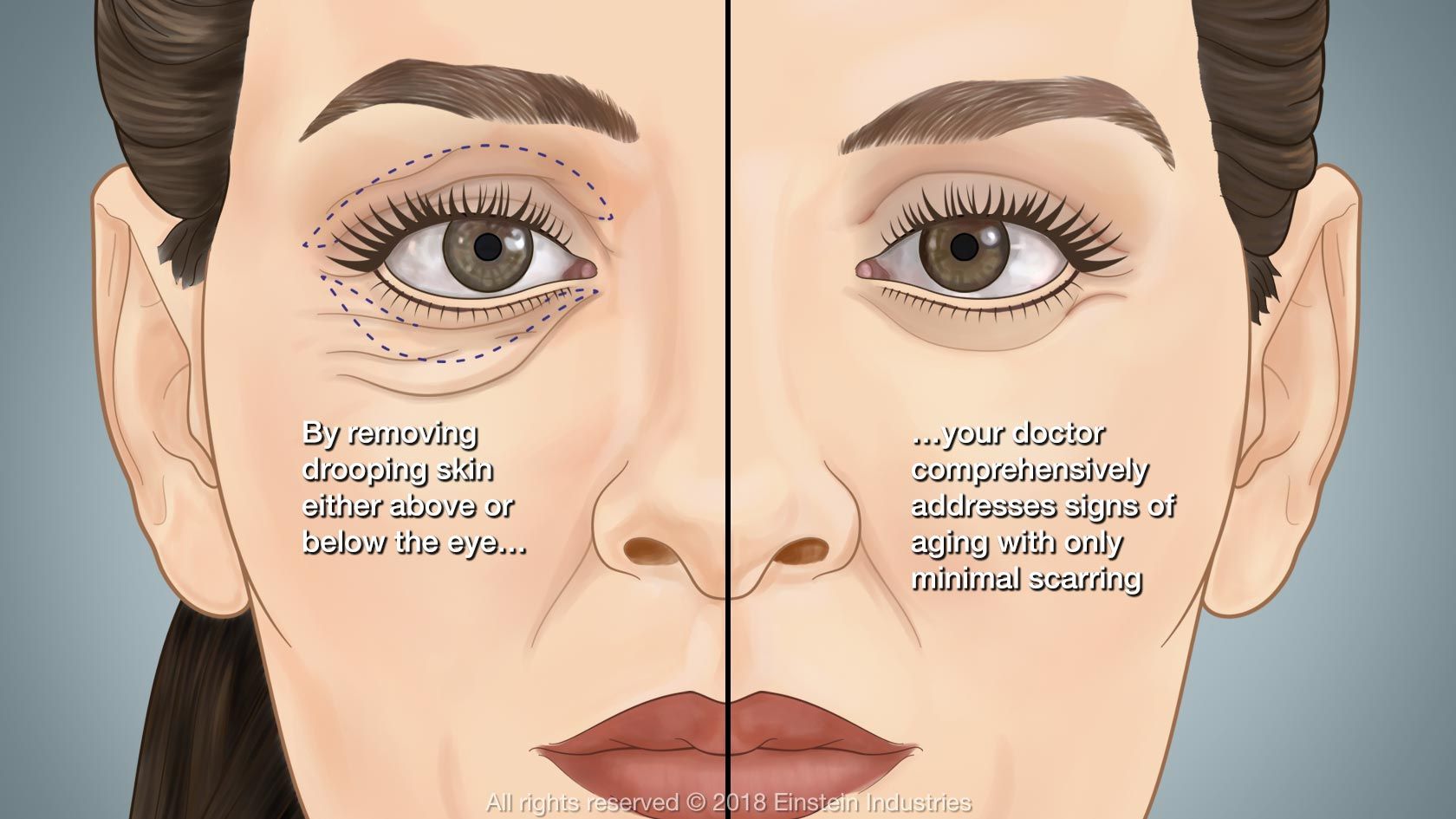 By removing drooping skin either above or below the eye, your doctor comprehensively addresses signs of aging with only minimal scarring